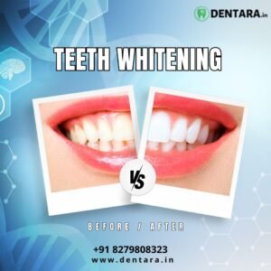 Best teeth whitening
