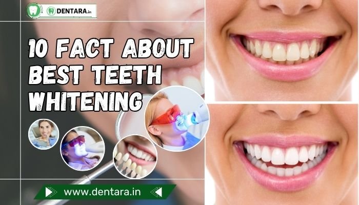 10 Fact About Best Teeth Whitening You Should Know